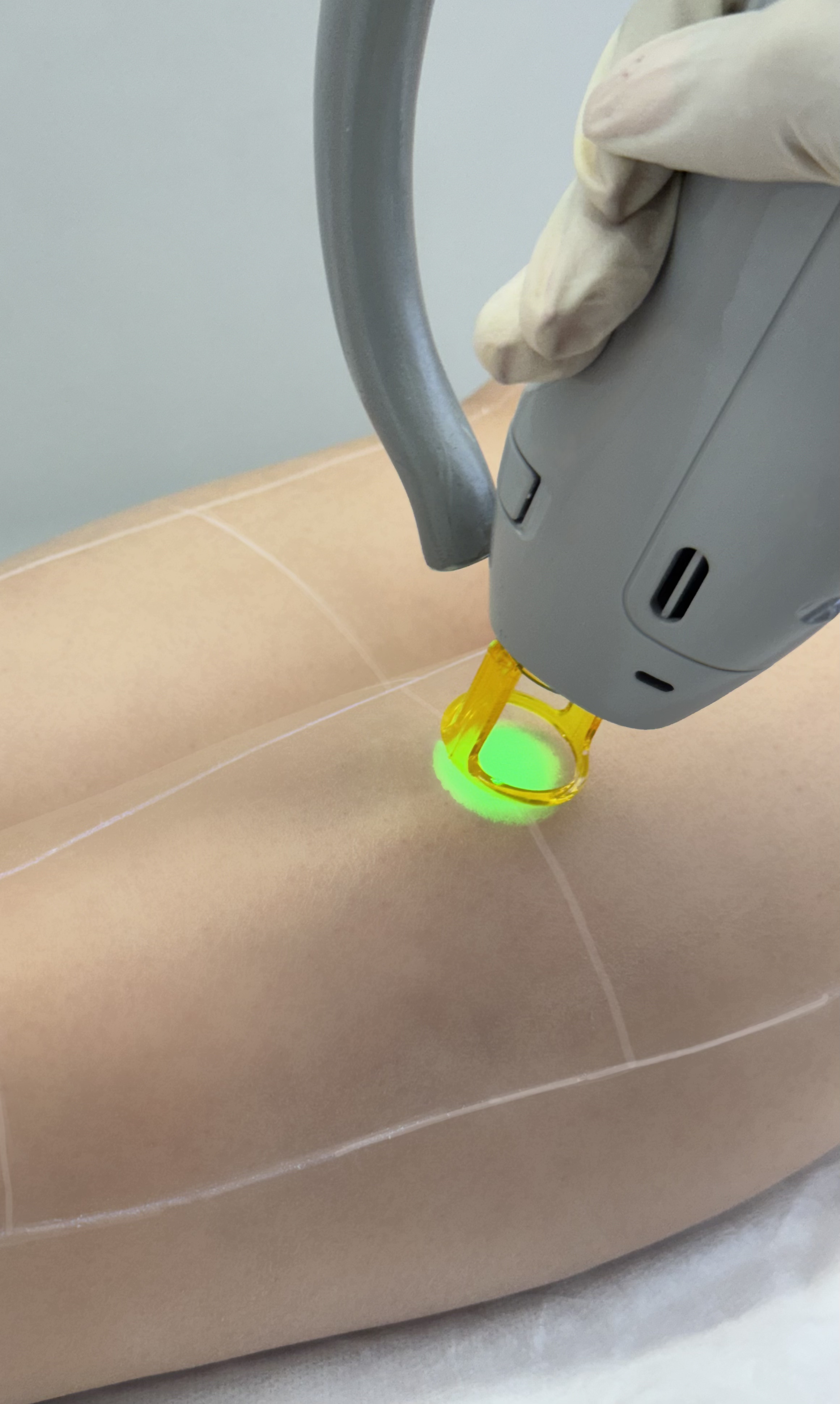 فرآیند لیزر درمانی